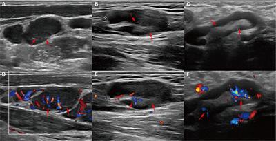 Ultrasound characterization of superficial lymph nodes in HIV patients with Talaromyces marneffei infection